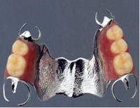 チタンの部分義歯