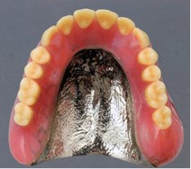 コバルトクロムの総義歯